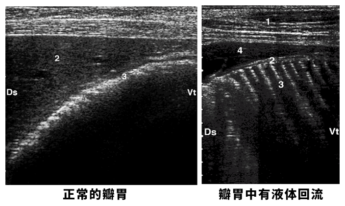 正常的瓣胃与不正常的瓣胃超声图像