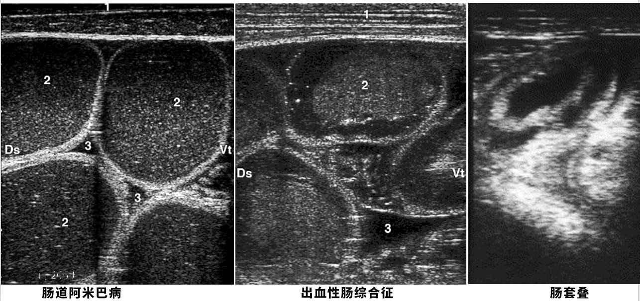 不正常的肠道超声图像