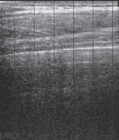 正常犊牛肺部超声图像